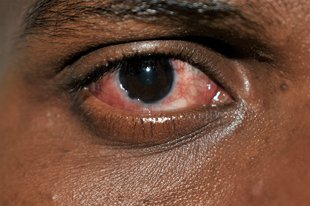 Picha inayoonyesha jicho lenye dalili za ugonjwa wa jicho nyekundu - conjunctivitis. Kwa hisani ya: www.nhs.uk .png